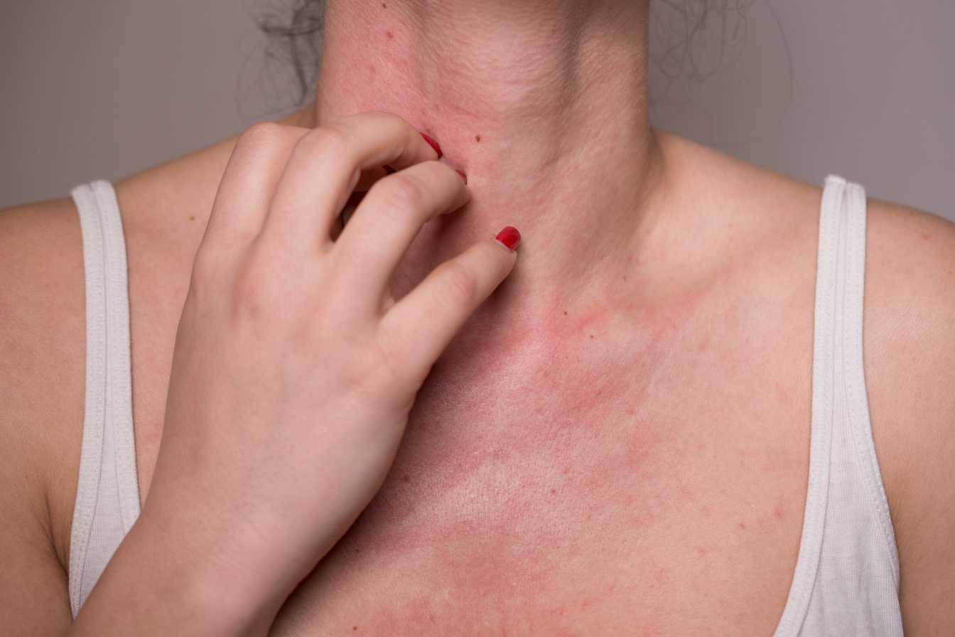allergie-au-poivre-2