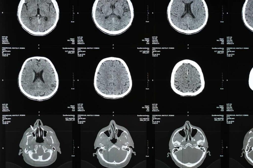 irm et sclerose en plaques comment cet examen detecte et suit la maladie 1