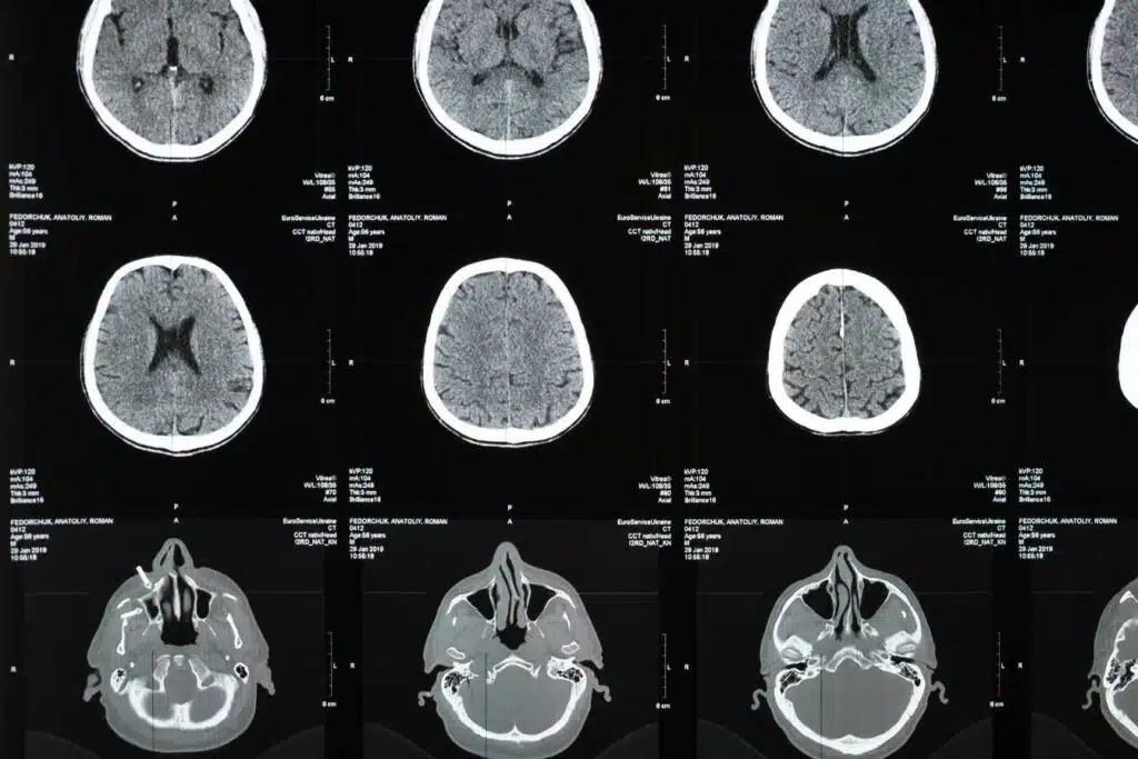 irm et sclerose en plaques comment cet examen detecte et suit la maladie 1