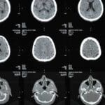 irm et sclerose en plaques comment cet examen detecte et suit la maladie 1