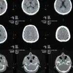irm et sclerose en plaques comment cet examen detecte et suit la maladie 1