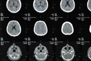 irm et sclerose en plaques comment cet examen detecte et suit la maladie 1