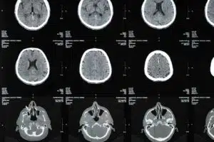 irm et sclerose en plaques comment cet examen detecte et suit la maladie 1