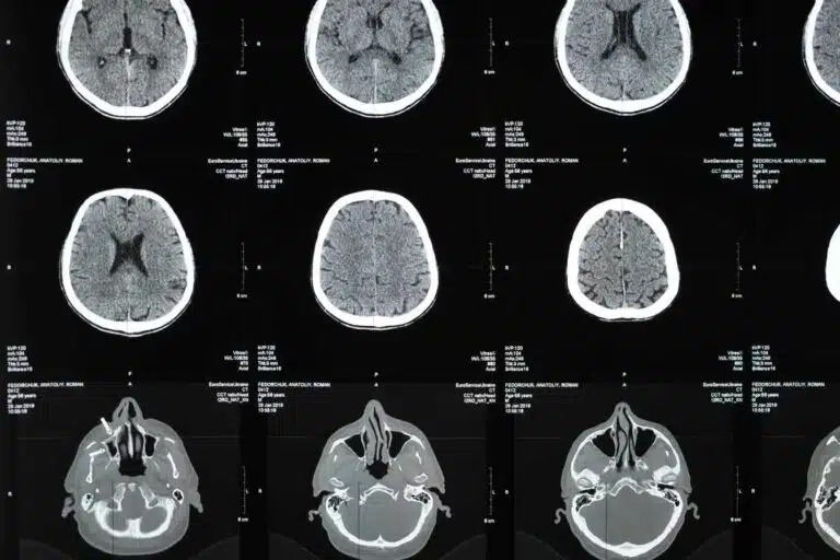 irm et sclerose en plaques comment cet examen detecte et suit la maladie 1