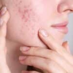 ma rosacee a disparu 1