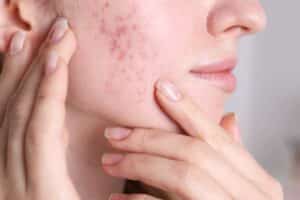 ma rosacee a disparu 1