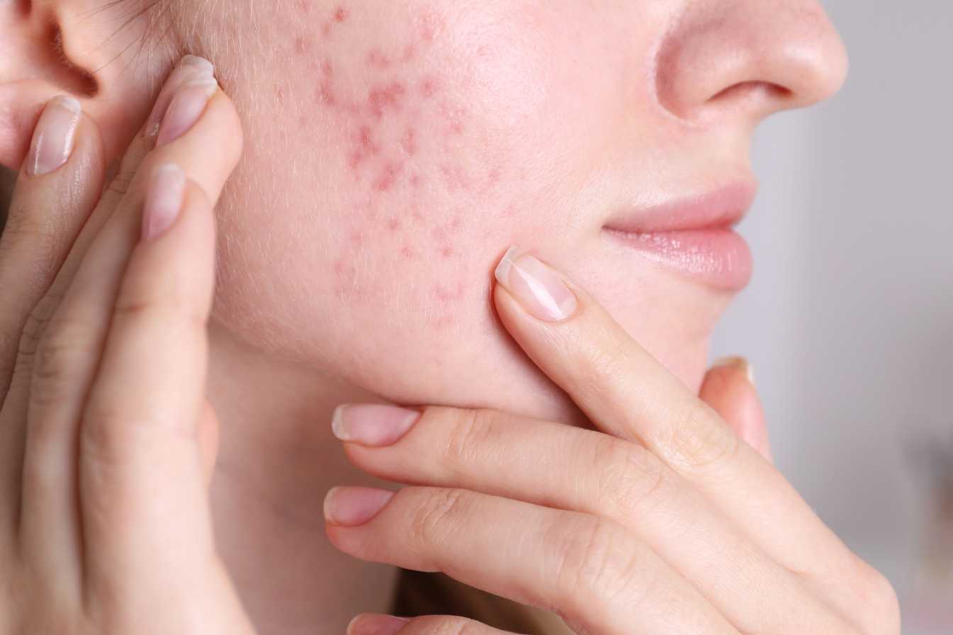 ma rosacee a disparu 1