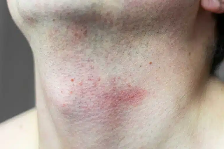 signe de darier 1