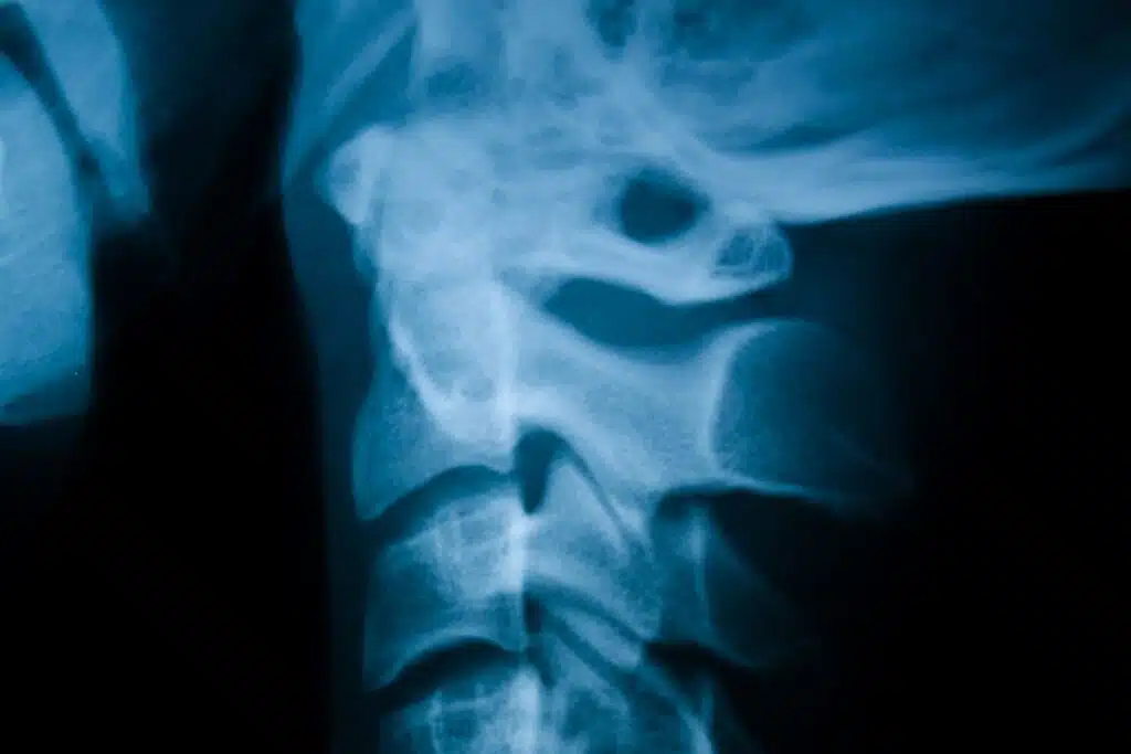 subluxation def 1