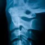 subluxation def 1